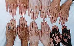 Hallan tratamiento para el encanecimiento y el vitiligo