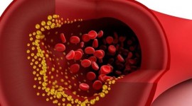 La hipertensión arterial altera la estructura de las arterias y acelera la aterosclerosis